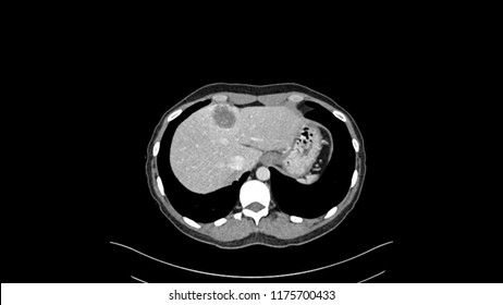 CT Scan And Liver Mass