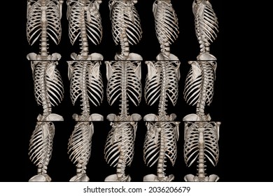 CT Scan Thoracic Spine 3D Rendering Image Case Trauma Fracture Thoracic Spine .