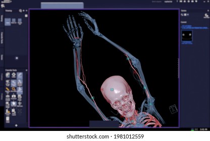 CTA Brachial Artery Or CT Scan Of Upper Extremity Or The Arm 3d Rendering Image On Blurred Screen.