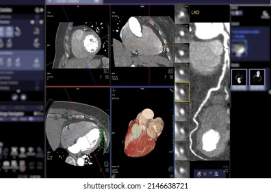 CTA Coronary Artery  3D Rendering Image On The Screen  For Diagnosis Of Vessel Coronary Artery Stenosis .