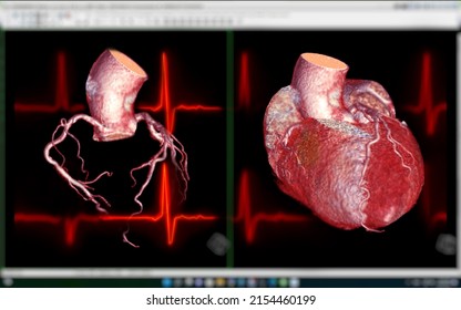 CTA Coronary Artery  3D Rendering Image On The Screen  For Diagnosis Of Vessel Coronary Artery Stenosis .