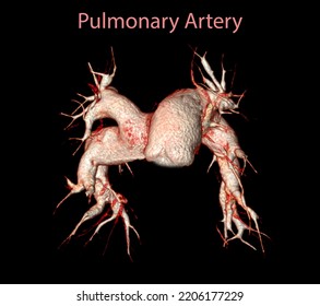 CTA Pulmonary Arteries 3D Rendering Showing Branch Of Pulmonary Artery