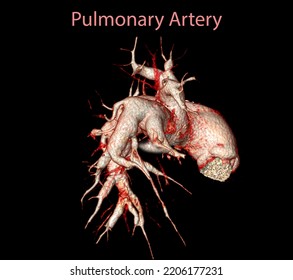 CTA Pulmonary Arteries 3D Rendering Showing Branch Of Pulmonary Artery