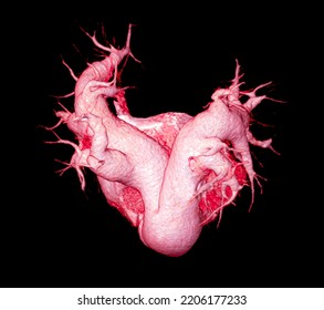 CTA Pulmonary Arteries 3D Rendering Showing Branch Of Pulmonary Artery