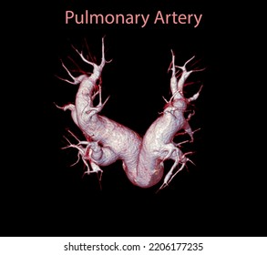 CTA Pulmonary Arteries 3D Rendering Showing Branch Of Pulmonary Artery