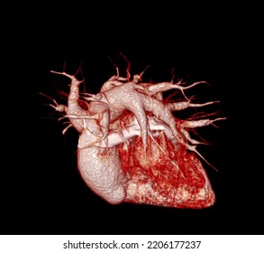 CTA Pulmonary Arteries 3D Rendering Showing Branch Of Pulmonary Artery