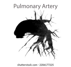 CTA Pulmonary Arteries Showing Branch Of Pulmonary Artery