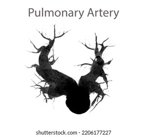 CTA Pulmonary Arteries Showing Branch Of Pulmonary Artery