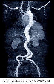 CTA Whoe Aorta With Curve MPR Technique Showing Abdominal Aorta And Left, Right Iliac Artery Showing Aortic Dissection .