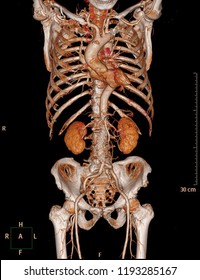 CTA Whole Aorta Or CT Angiography 3D Rendering Image With Abdominal Aorta Stent Graft.