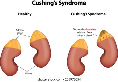 Cushing's Syndrome