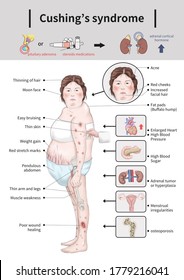 
Cushing's Syndrome Cause And Symptoms Medical Illustration