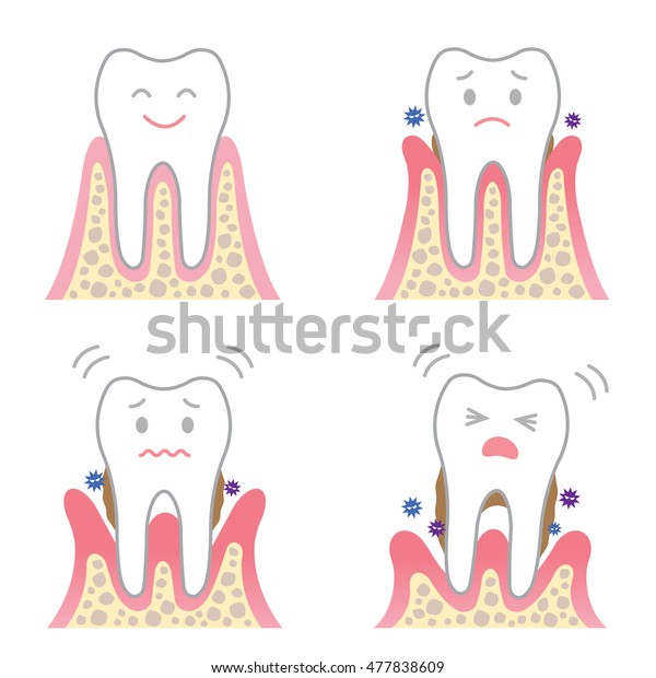 歯周病の可愛い漫画のキャラクター 歯肉疾患の4段階の症状 のイラスト素材