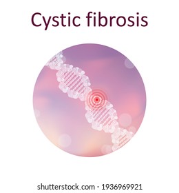 Cystic fibrosis. Genetic. DNA double helix. Medical illustration.