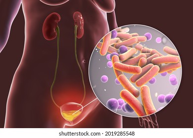 Cystitis, bacterial infection of urinary bladder, conceptual 3D illustration showing bacteria in urine