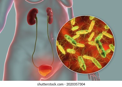 Cystitis, Bacterial Infection Of Urinary Bladder, Conceptual 3D Illustration Showing Bacteria In Urine