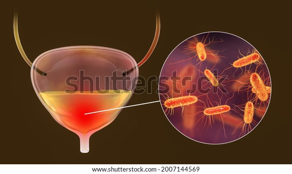 Cystitis Bacterial Infection Urinary Bladder Conceptual Stock Illustration 2007144569 Shutterstock 