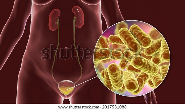 Cystitis, bacterial infection\
of urinary bladder, conceptual 3D illustration showing bacteria in\
urine