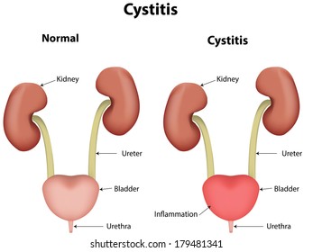 Cystitis, Urinary Tract Infection