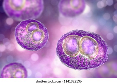 Cytomegalovirus CMV In Human Cell, Owl's Eye Inclusion In Nucleus, Multinucleated Cell, 3D Illustration. It Is Herpes Virus, Causes Disease In Fetus, Organ Transplant Patients, HIV Infected People