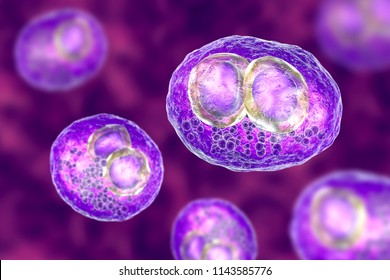 Cytomegalovirus CMV In Human Cell, Owl's Eye Inclusion In Nucleus, Multinucleated Cell, 3D Illustration. It Is Herpes Virus, Causes Disease In Fetus, Organ Transplant Patients, HIV Infected People