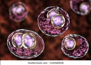 Cytomegalovirus CMV In Human Cell, Owl's Eye Inclusion In Nucleus, Multinucleated Cell, 3D Illustration. It Is Herpes Virus, Causes Disease In Fetus, Organ Transplant Patients, HIV Infected People