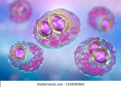 Cytomegalovirus CMV In Human Cell, Owl's Eye Inclusion In Nucleus, Multinucleated Cell, 3D Illustration. It Is Herpes Virus, Causes Disease In Fetus, Organ Transplant Patients, HIV Infected People