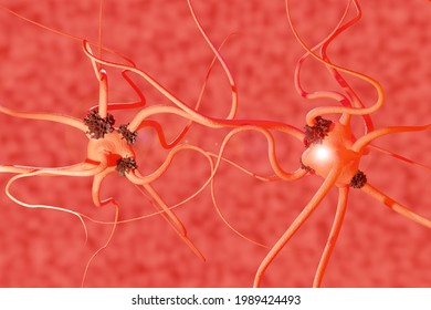 Damage to brain neurons in Parkinson's disease. Synapses of neurons affected by Altsheimer's disease. 3d rendering - Powered by Shutterstock