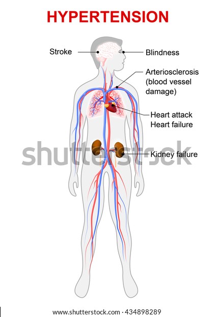 Damage High Blood Pressure Stock Illustration 434898289 damage-high-blood-pressure-stock-illustration-434898289