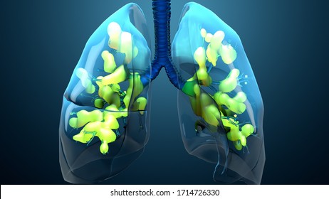 Damage Lungs, Severe Respiratory Illness, Pneumonia, ARDS, Acute Respiratory Distress Syndrome Caused By The Coronavirus 3d Illustration