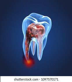 Damaged Teeth Xray View. Medically Accurate Tooth 3D Illustration