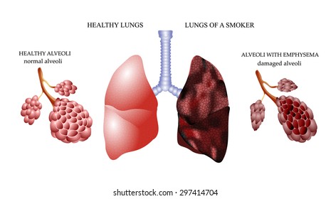 The Dangers Of Smoking, The Lungs Of A Healthy Person And Smoker