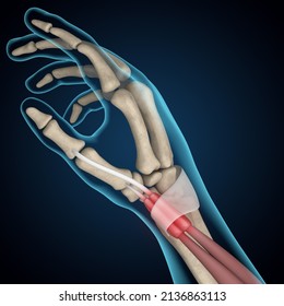 De Quervain's Tenosynovitis 3D Rendering, Mommy's Wrist, Mommy's Thumb, Thumb Pain, Wrist Pain, Hand Anatomy, Tendon, Tendon Sheath, Ligaments