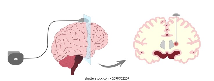 Deep brain stimulation (DBS) illustration. Electrodes placement for deep brain stimulation with a sagital perspective.