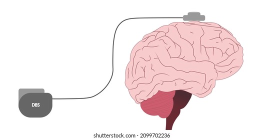 Deep brain stimulation (DBS) illustration. Electrodes placement for deep brain stimulation. 