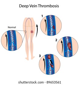 Deep Vein Thrombosis