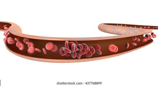 Deep Vein Thrombosis, A Blood Clot Within A Vein