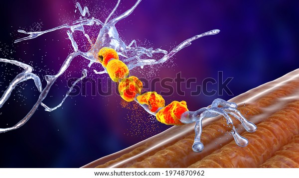 Degradation of motor neurons, conceptual 3D\
illustration. Motor neuron diseases are a group of\
neurodegenerative disorders including amyotrophic lateral\
sclerosis, progressive bulbar palsy and\
other