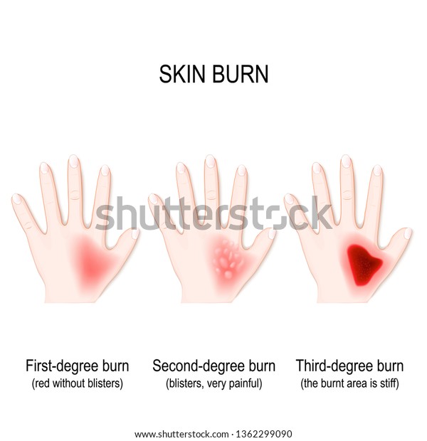 Degree Burns Skin Step Burn Human Stock Illustration 1362299090 ...