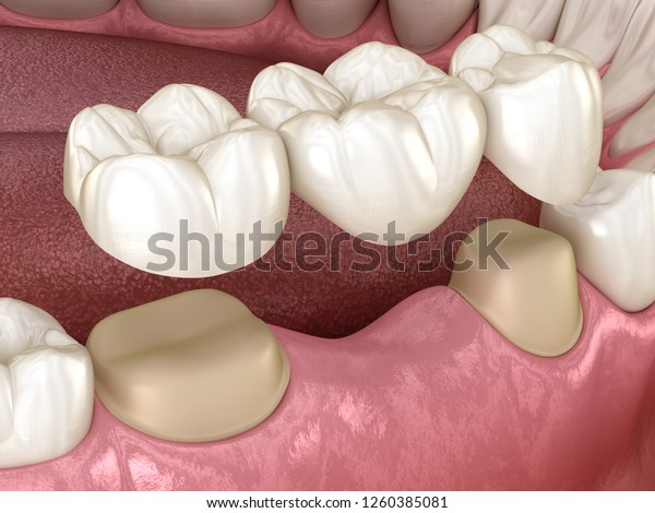 Dental bridge of 3
teeth over molar and premolar. Medically accurate 3D illustration
of human teeth
treatment