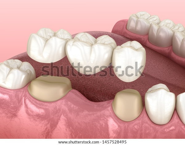 Dental bridge of 3
teeth over molar and premolar. Medically accurate 3D illustration
of human teeth
treatment