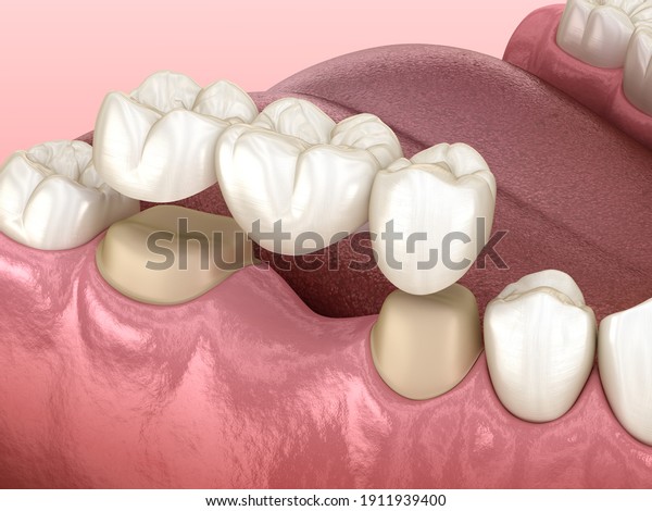 Dental bridge of 3\
teeth over molar and premolar. Medically accurate 3D illustration\
of human teeth\
treatment