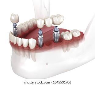 Dental bridge and crown placement over implants. Dental 3D animation concept - Powered by Shutterstock