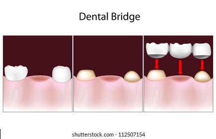 Dental Bridge Procedure