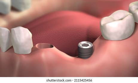 The Dental Bridge Was Removed From Two Implants. In Order To Fill With Bone Graft The Place Where The Bone Sank. 3D Rendering Of Teeth. Bone Augmentation Procedure. Lower Arch.