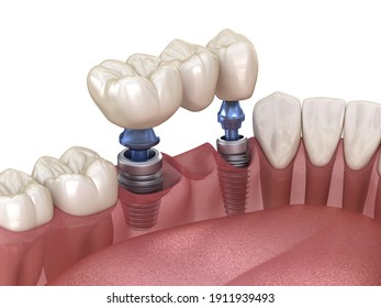 Dental bridge supported by implants. Medically accurate 3D illustration of human teeth and dentures concept
