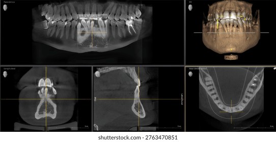 Dental cbct scan displaying multiple views of a human jaw and teeth, assisting in diagnosis and treatment planning
