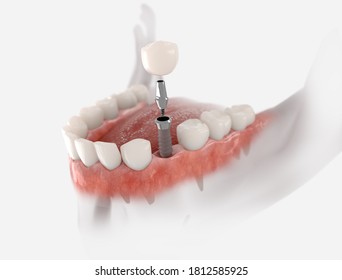 Dental crown, abutment and implant. 3D illustration of human teeth and dentures on white background. - Powered by Shutterstock