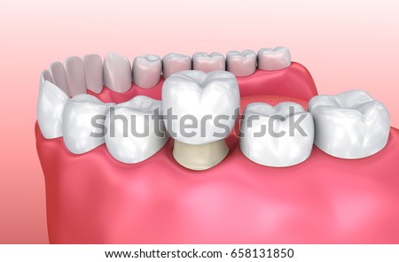Dental crown installation process, Medically accurate 3d illustration