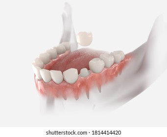 Dental crown placement process. 3d illustration on whit background.